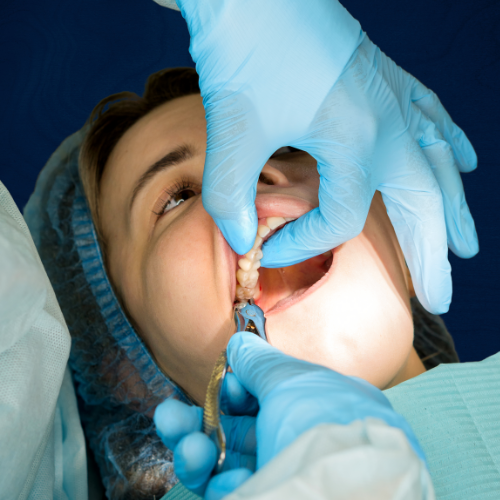 Tooth Extraction