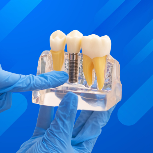 Dental Implants