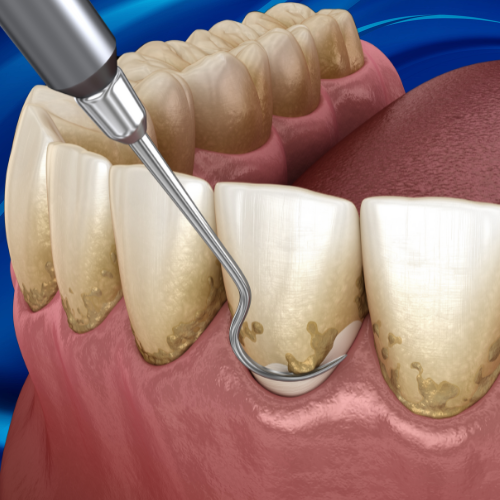 Teeth Cleaning