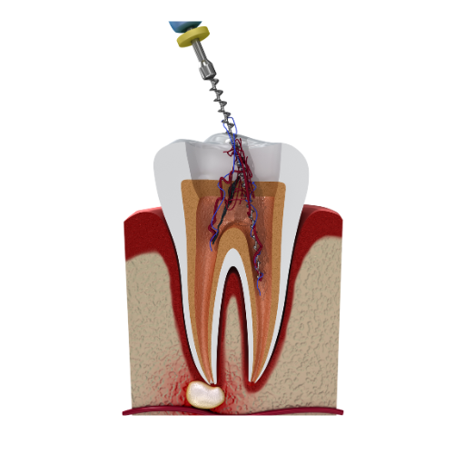 RootCanal Treatment